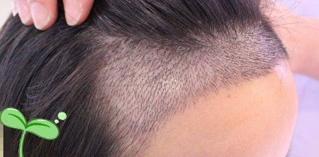 -大麦微针植发丨全国连锁