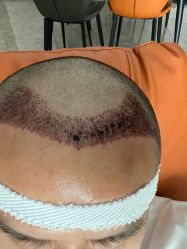 -大麦微针植发全国连锁