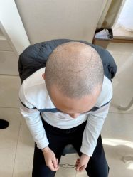 -大麦微针植发丨全国连锁