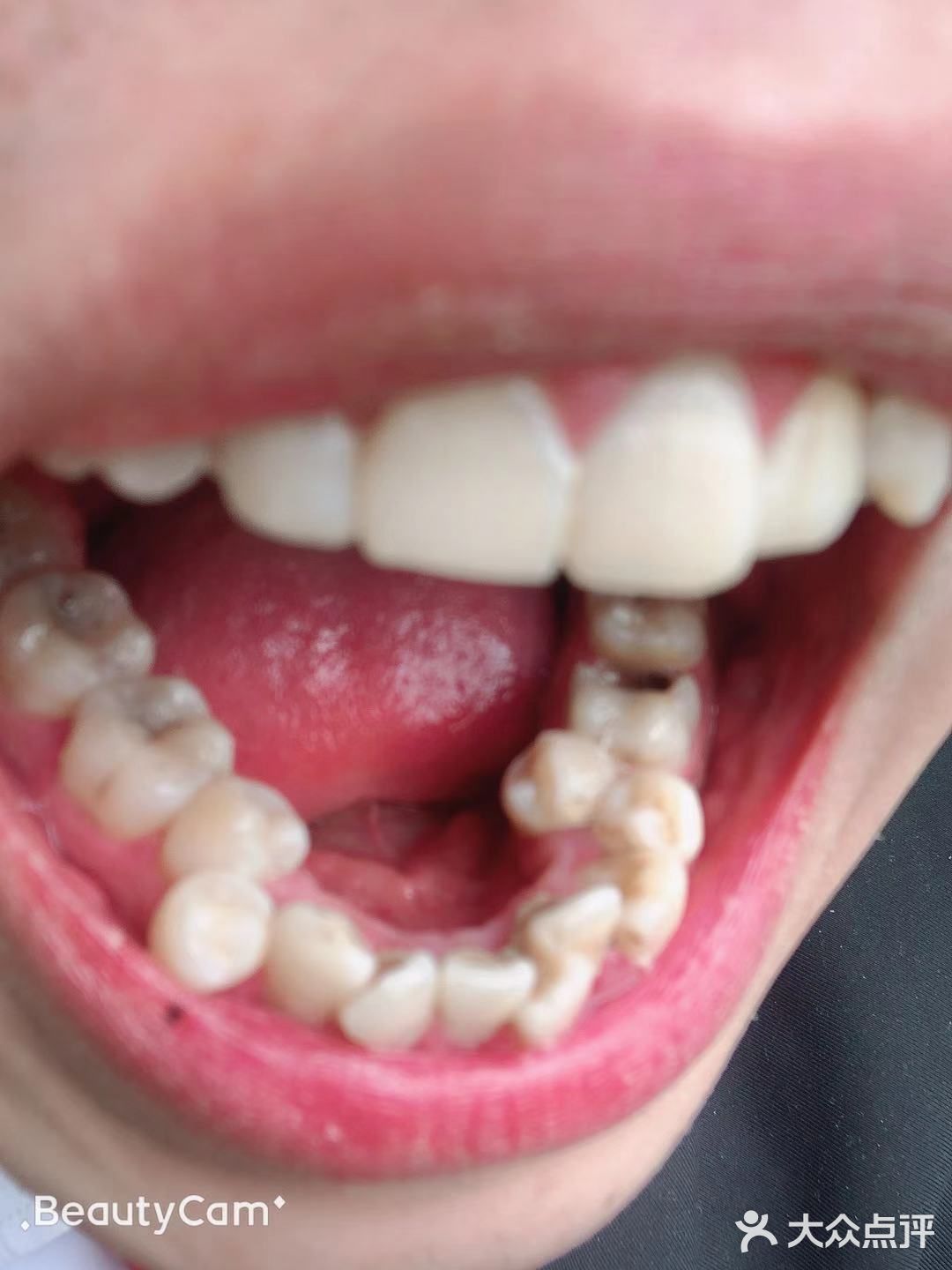 定期洁牙给你带来的意外和惊喜