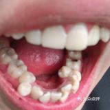 定期洁牙给你带来的意外和惊喜