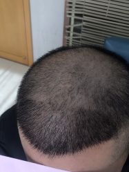 点击看大图 体验后-大麦微针植发丨全国连锁