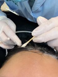 -碧莲盛·不剃发植发