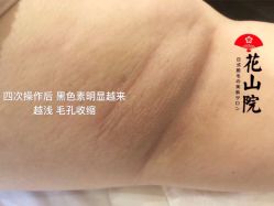 -觅屿日式脱毛美肤