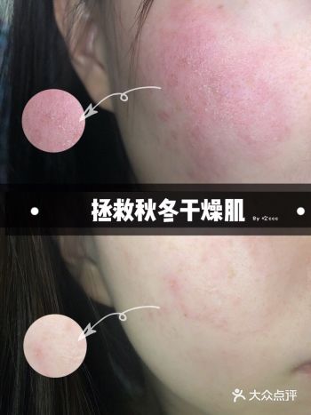 如何快速有效的拯救秋冬干燥肌