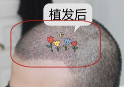 -大麦微针植发全国连锁