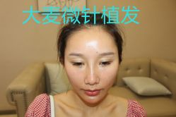 -大麦微针植发丨全国连锁