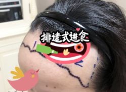 -大麦微针植发全国连锁