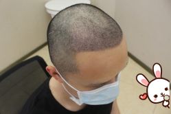 -大麦微针植发丨全国连锁