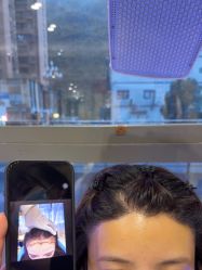 -碧莲盛·不剃发植发