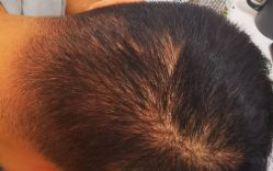 体验后-大麦微针植发全国连锁