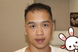 -大麦微针植发丨全国连锁