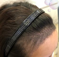 -大麦微针植发丨全国连锁