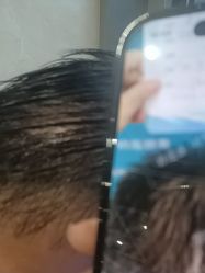 -碧莲盛·不剃发植发