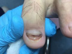 -Andrew指甲专科灰指甲·甲沟炎矫正·3D步态矫形鞋垫定制(浦三路店)