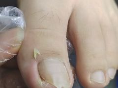 -祖传修脚甲沟炎灰指甲鸡眼
