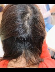 点击看大图 -大麦微针植发全国连锁