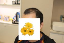 -大麦微针植发丨全国连锁