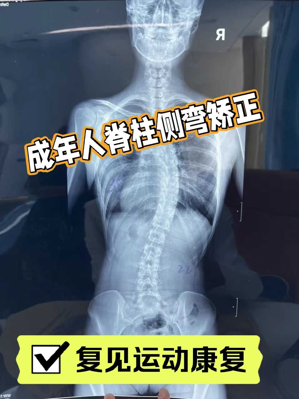 成年人脊柱侧弯还能矫正吗?可以!改善体态,预防疼痛,运动康复