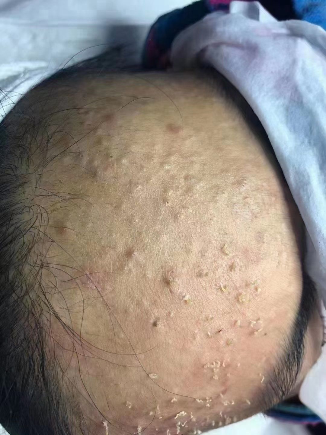 额头上为什么长痘痘呢
