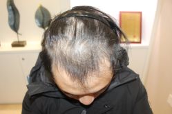 -大麦微针植发丨全国连锁