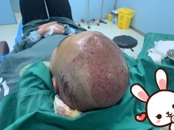 点击看大图 -大麦微针植发丨全国连锁