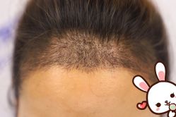 -大麦微针植发丨全国连锁