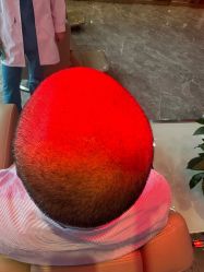 -碧莲盛·不剃发植发