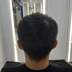 -大麦微针植发全国连锁