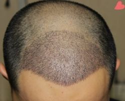 -大麦微针植发丨全国连锁