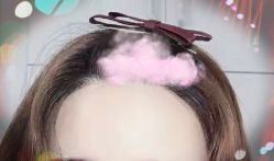 -大麦微针植发全国连锁