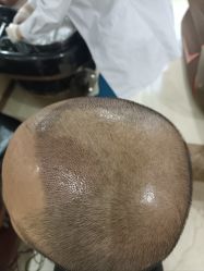 -碧莲盛·不剃发植发