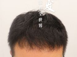 -大麦微针植发全国连锁