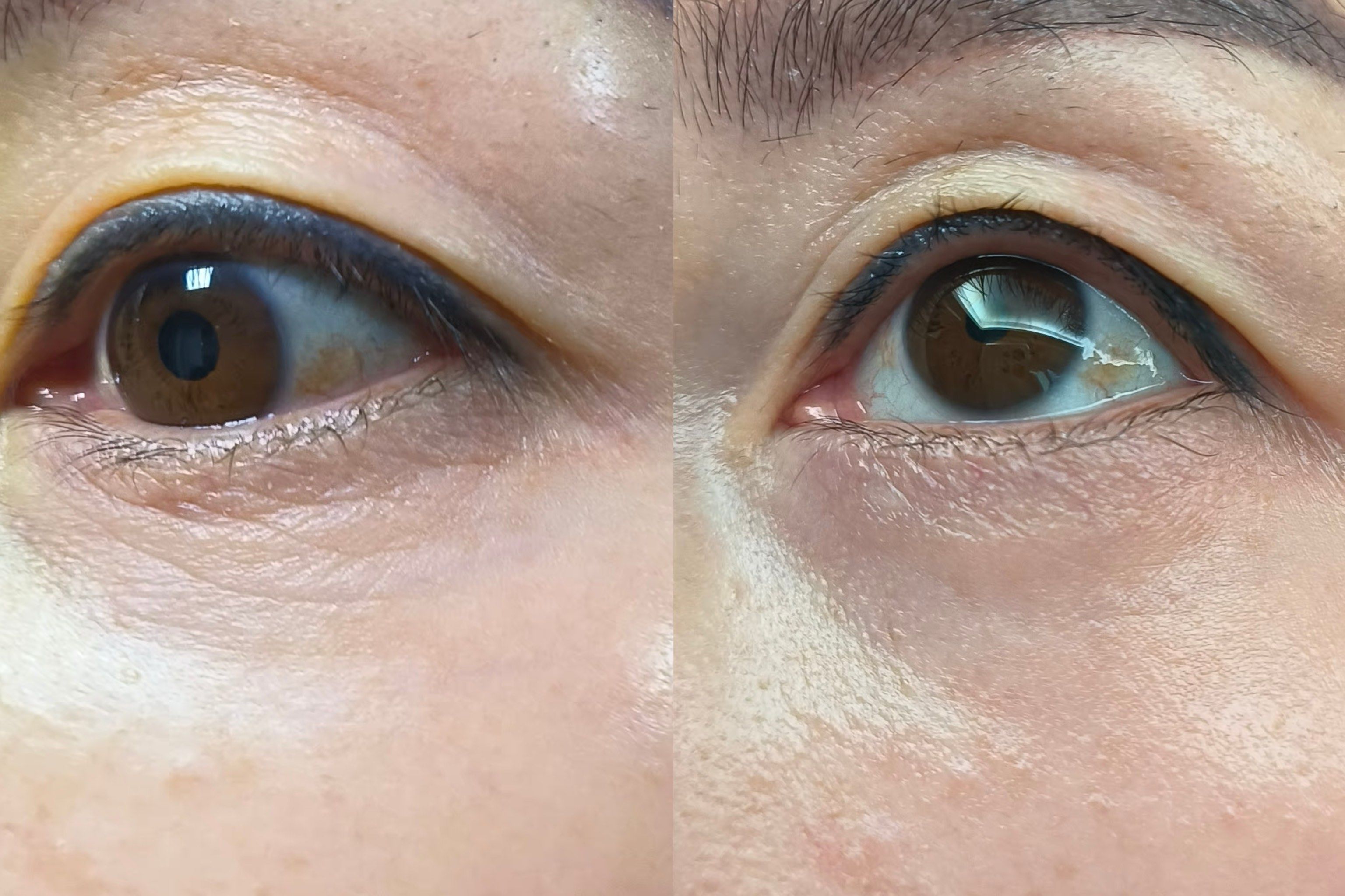 眼睛细纹有救了,这效果也太好了吧