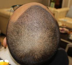 -大麦微针植发丨全国连锁