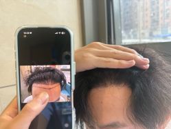 -碧莲盛·不剃发植发