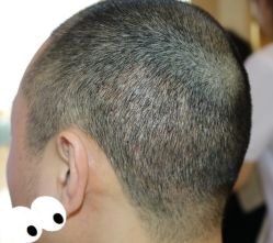 -大麦微针植发丨全国连锁