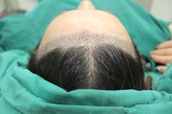 -大麦微针植发丨全国连锁