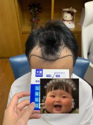 -大麦微针植发全国连锁