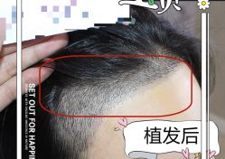 -大麦微针植发全国连锁