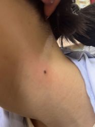 体验后-北京美痣堂古方祛痣斑疣瘊