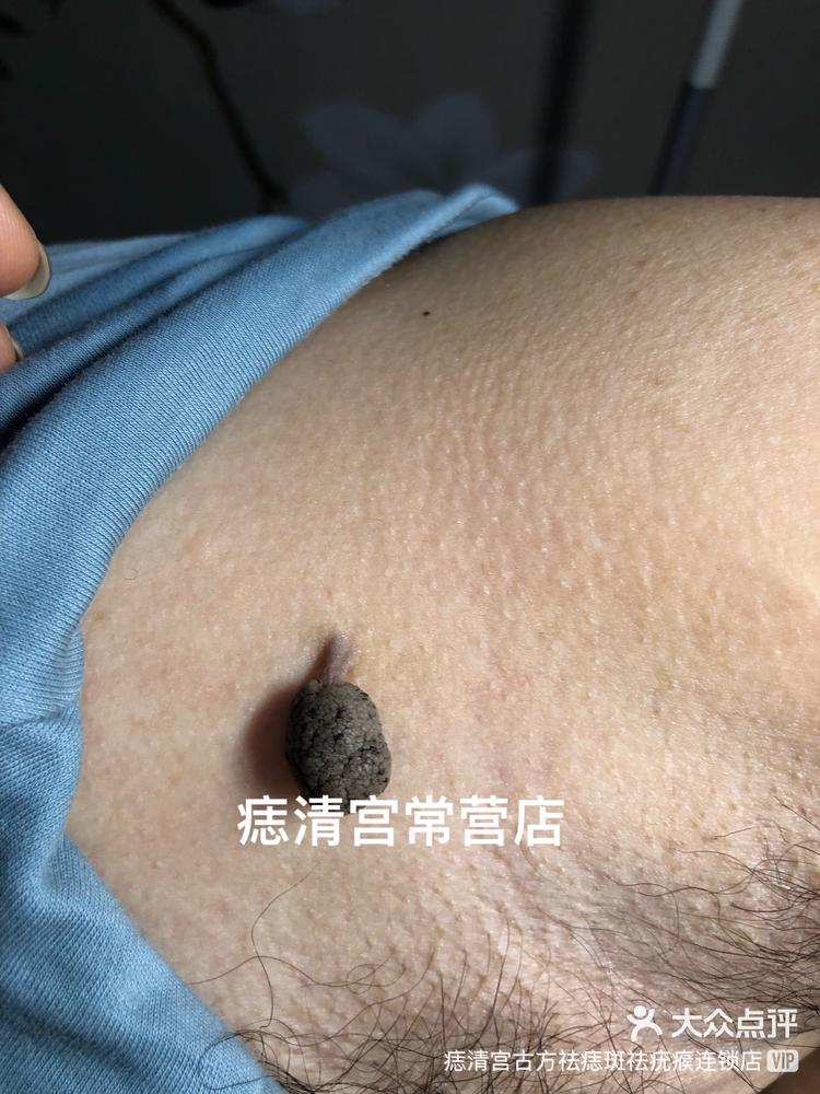 痣清宫古方祛痣斑祛疣瘊连锁店 5月17日 14:35 关注 见过身上会开花的