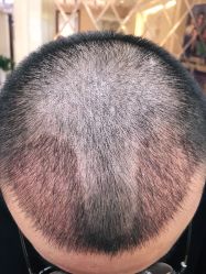 -碧莲盛·不剃发植发