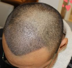 -大麦微针植发丨全国连锁