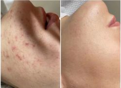 -美肤盾祛痘·问题肌头疗管理中心