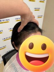 -大麦微针植发全国连锁