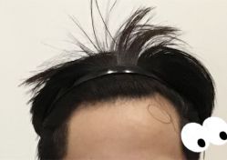 -大麦微针植发全国连锁