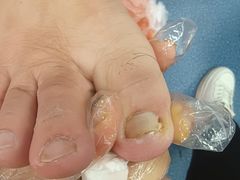 -新甲连锁灰指甲·甲沟炎·修脚(爱联店)