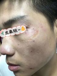 -痣斑堂·取大痣