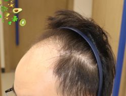 -大麦微针植发全国连锁